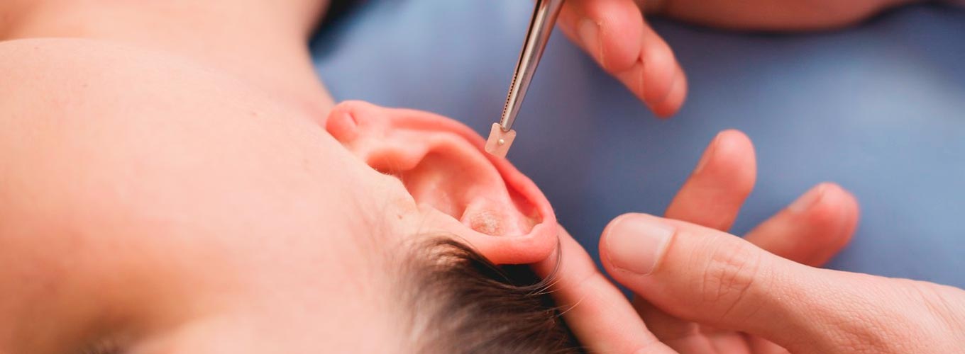 sessão de auriculoterapia